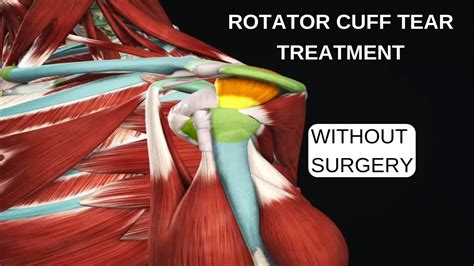 Rotator Cuff Tear Treatment Exercises