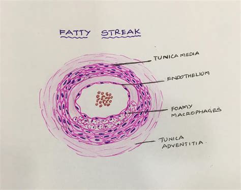 MORPHOLOGY OF ATHEROSCLEROSIS – Histopathology.guru