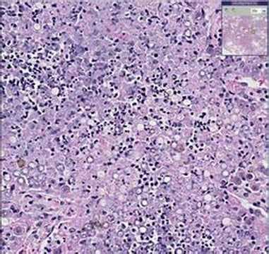 Histopathology Lung--Blastomycosis - YouTube