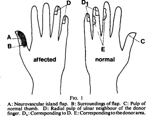 Figure I from The neurovascular island flap for defective sensibility ...