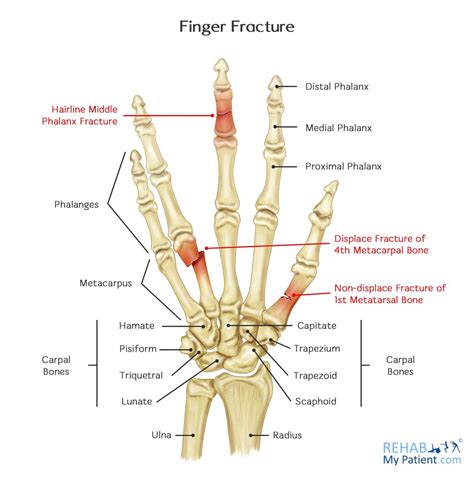 Finger Fracture | Rehab My Patient