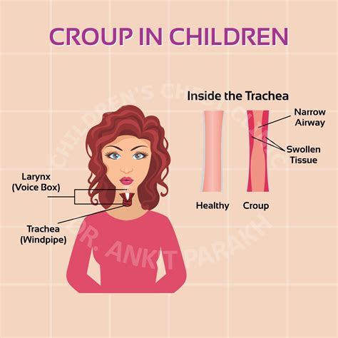 Croup in Children - Symptoms, Diagnosis and Treatment - Dr. Ankit Parakh