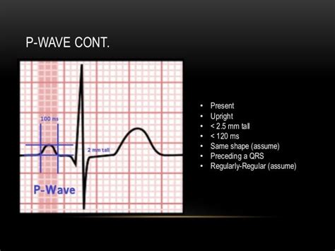 P wave axis and escape rhythms