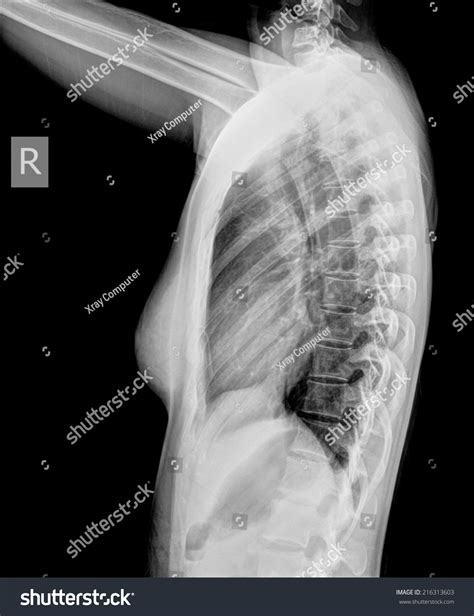 Film X-ray Women Upper Thoracic Spine Stock Photo 216313603 | Shutterstock