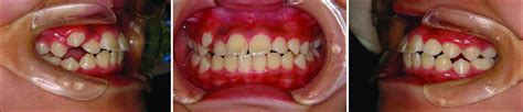 Change in the mesiodistal axial inclination of the maxillary lateral ...