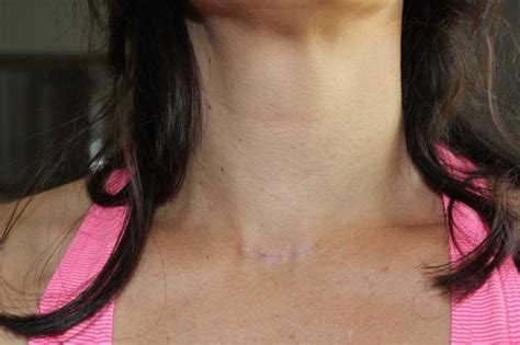 Thyroid Cancer Surgery