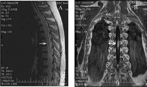 A confounding coincidence: epidural anesthesia and paraplegia due to ...