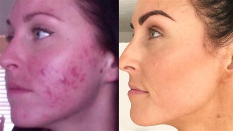 Blogger Juli Bauer Roth Shares Cystic Acne Before and After Photos | Allure