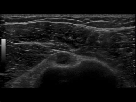 Complete tear long head of biceps tendon | Ultrasound Cases