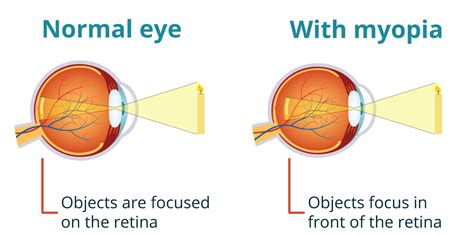 Myopia Management - Innovision Family Eye Care Tx.