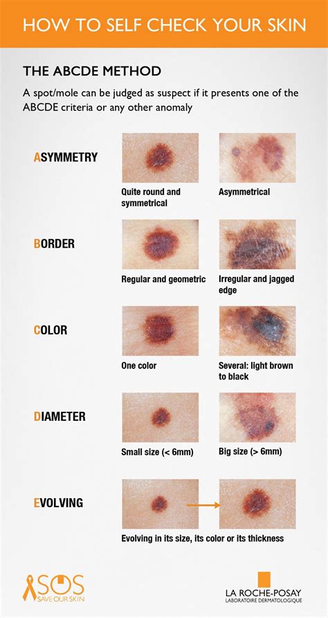 Abcde Skin Cancer Chart