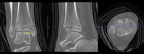 Maisonneuve Fracture Treatment Orthobullets : Ankle Fractures Trauma ...