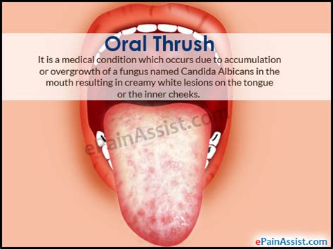 Oral Thrush: Causes, Treatment, Home Remedies, Prevention