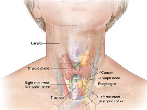 Targeted Therapies Show Initial Effectiveness in Subset of Papillary ...