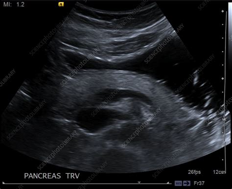 Normal pancreas, ultrasound - Stock Image - C039/3195 - Science Photo ...