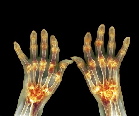 Case Study: Cardiac Manifestations of Rheumatoid Arthritis