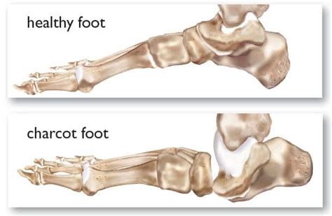 Complications with Charcot Foot | International Orthotic Labs