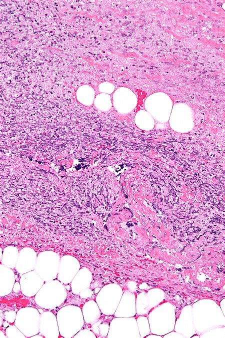 Necrotizing fasciitis - Libre Pathology