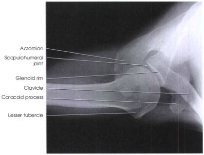 INFEROSUPERIOR AXIAL SHOULDER X-RAY - RadTechOnDuty