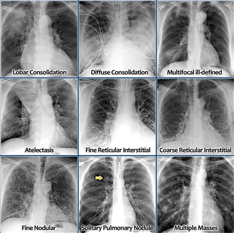 Chest X Ray Pneumonia Vs Lung Cancer - CancerWalls