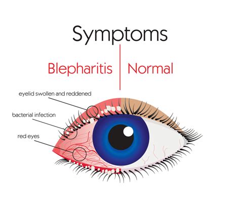 Blepharitis: Symptoms and Treatment | Fort Lauderdale Eye Institute