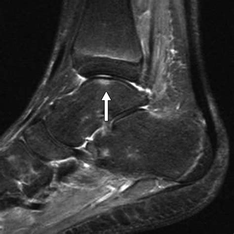 Bone Marrow Edema Patterns in the Ankle and Hindfoot: Distinguishing ...