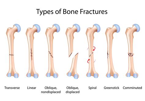 Types of Broken Bones: Symptoms, Treatment, Healing - Hernando ...