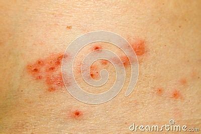 Shingles Rash Stock Photos - Image: 28588363