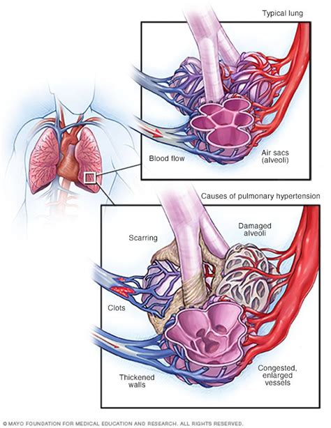 Pulmonary hypertension - Symptoms and causes - Mayo Clinic