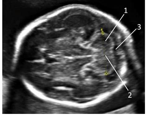 Cerebellar Vermis Fetal Ultrasound