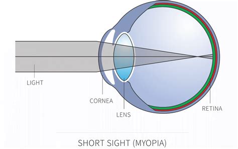 how do glasses work for long sightedness - Jefferey Lear