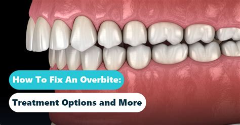 How To Cure Overbite - Proofcheek Spmsoalan