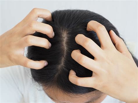 Scalp Eczema: Symptoms, Causes & Treatment - K Health