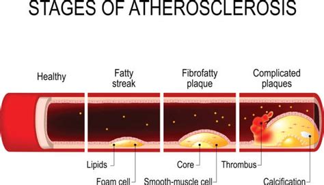 The 4 Stages Of Atherosclerosis