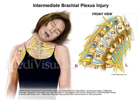 Understanding the Brachial Plexus Injury: Part 1 - Medivisuals Inc.