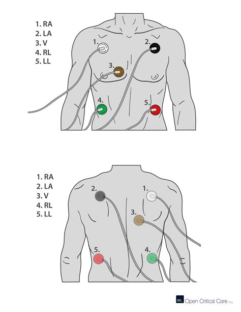 Neonatal Ecg Electrode Placement