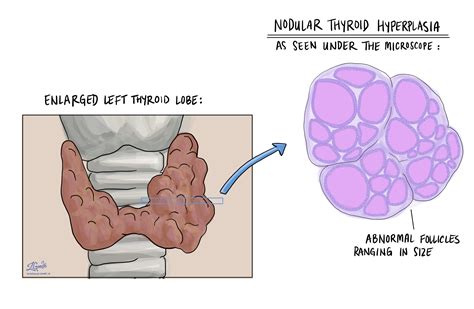 Nodular thyroid hyperplasia - MyPathologyReport.ca