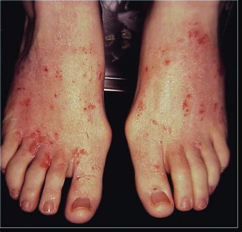 pruritus symptoms - pictures, photos