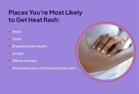 Heat Rash: Signs, Duration, and Treatment