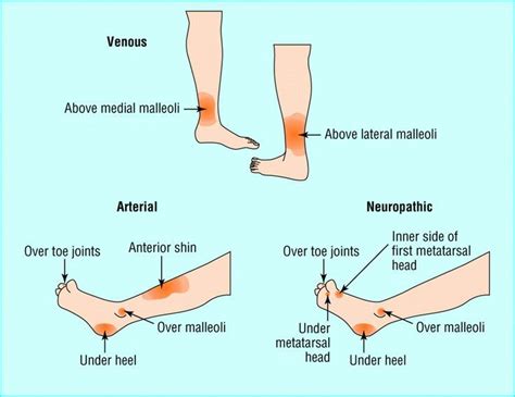 98 best Venous Insufficiency Information images on Pinterest | Nurses ...