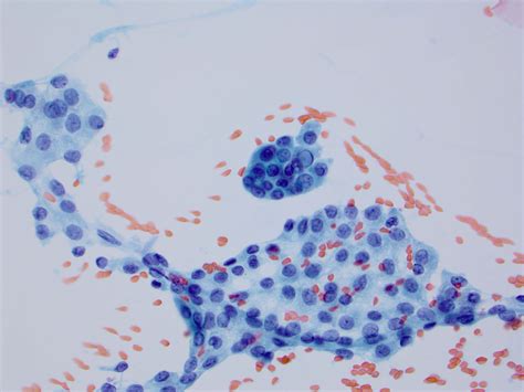 Thyroid Cytology