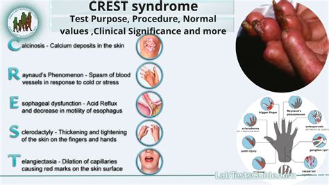 CREST Syndrome | Lab Tests Guide