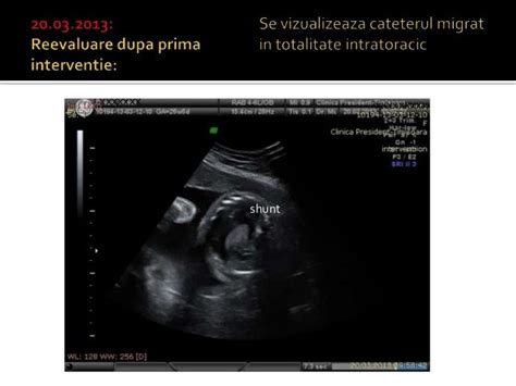 Hidrotorax fetal shunt pleuro amniotic