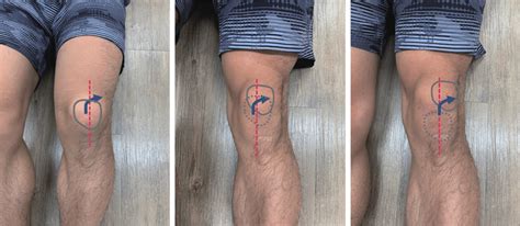 The "J"-sign, known as the lateral patellar tracking on anterior view ...