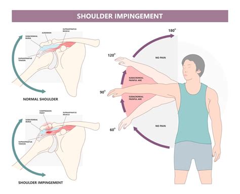 Shoulder Impingement Syndrome Causes, Treatment, Prevention, 49% OFF