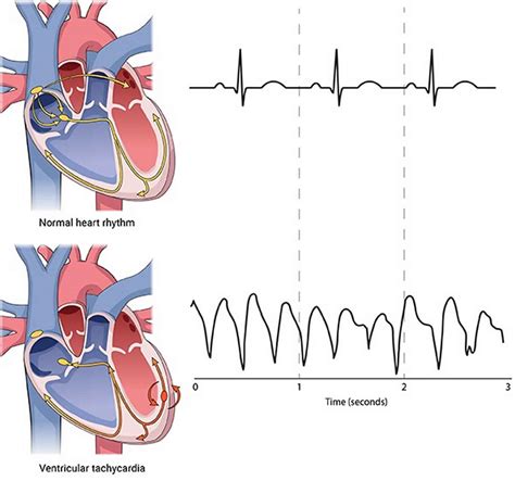 Ventricular fibrillation causes, symptoms, diagnosis, treatment & prognosis