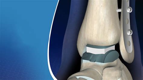 Ankle Replacement Surgery Procedure, Post Measures and Projections