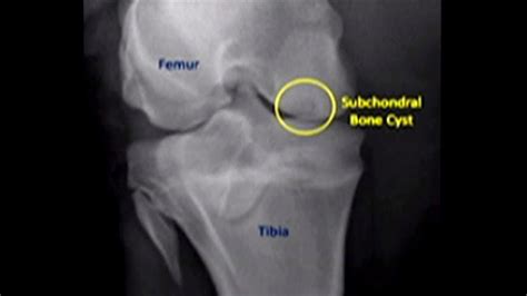 Subchondral Cyst