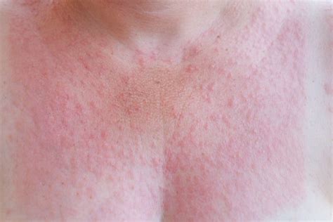 Sun Rash: What to Know About Photosensitivity - Water's Edge Dermatology