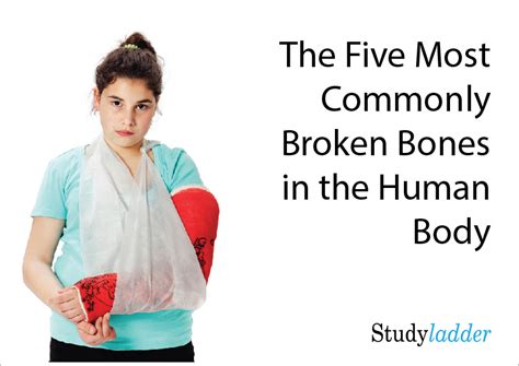 5 Most Commonly Broken Bones - Studyladder Interactive Learning Games